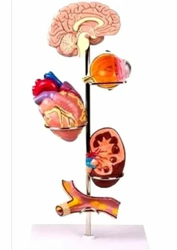Pvc Effects of Hypertension Model SF00000896